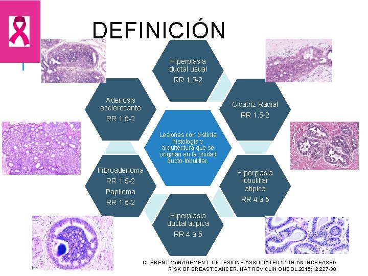 DEFINICIÓN Hiperplasia ductal usual RR 1. 5 -2 Adenosis esclerosante RR 1. 5 -2