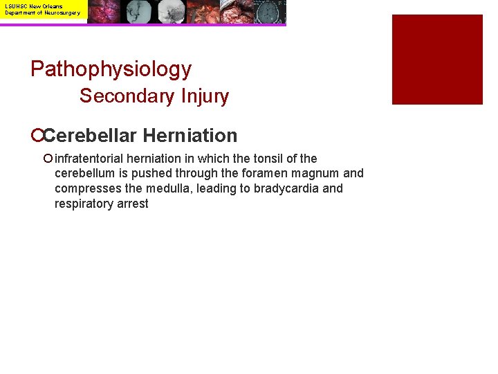 LSUHSC New Orleans Department of Neurosurgery Pathophysiology Secondary Injury ¡Cerebellar Herniation ¡ infratentorial herniation