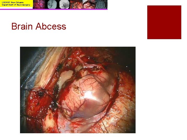 LSUHSC New Orleans Department of Neurosurgery Brain Abcess 