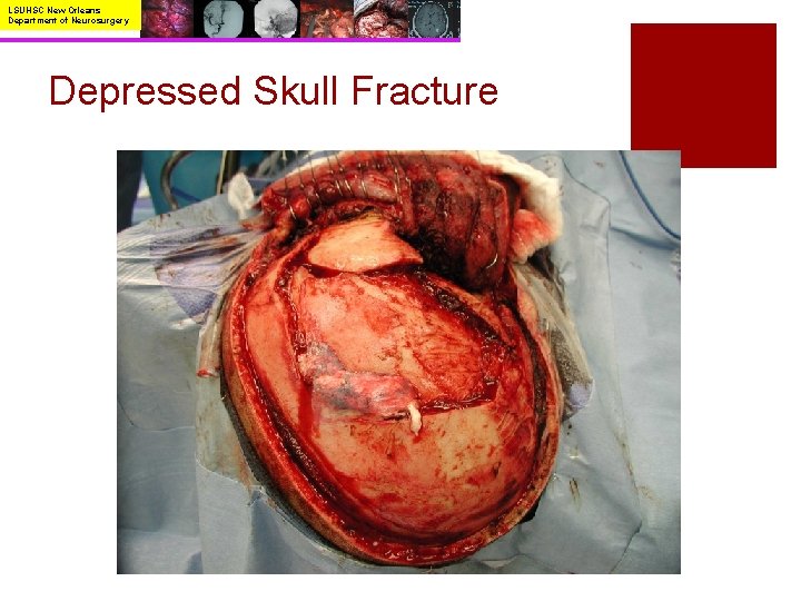 LSUHSC New Orleans Department of Neurosurgery Depressed Skull Fracture 