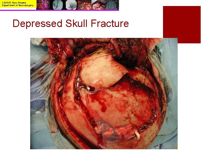 LSUHSC New Orleans Department of Neurosurgery Depressed Skull Fracture 