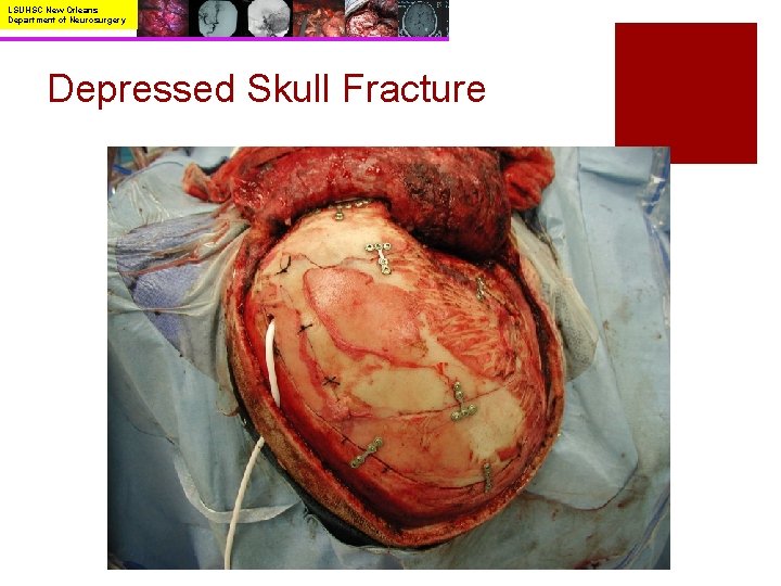 LSUHSC New Orleans Department of Neurosurgery Depressed Skull Fracture 