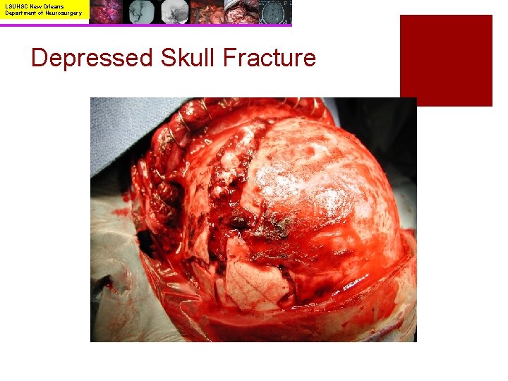 LSUHSC New Orleans Department of Neurosurgery Depressed Skull Fracture 