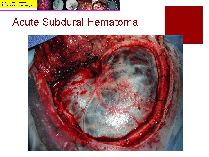 LSUHSC New Orleans Department of Neurosurgery Acute Subdural Hematoma 