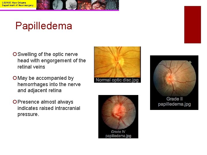 LSUHSC New Orleans Department of Neurosurgery Papilledema ¡ Swelling of the optic nerve head
