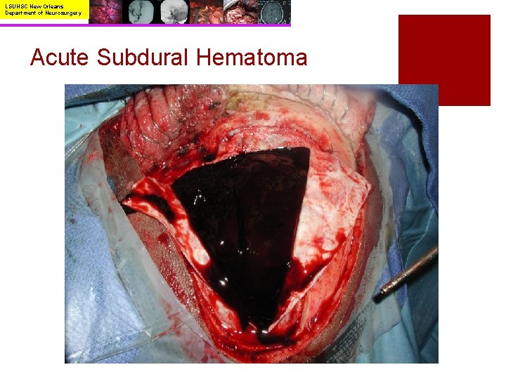 LSUHSC New Orleans Department of Neurosurgery Acute Subdural Hematoma 