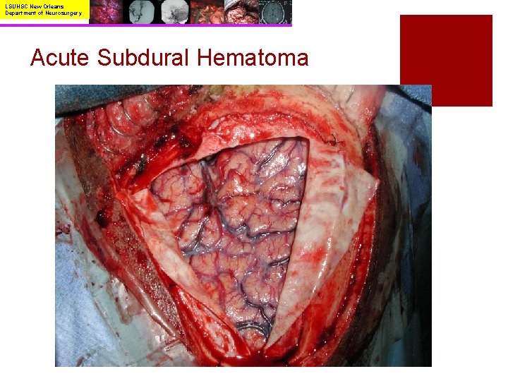 LSUHSC New Orleans Department of Neurosurgery Acute Subdural Hematoma 