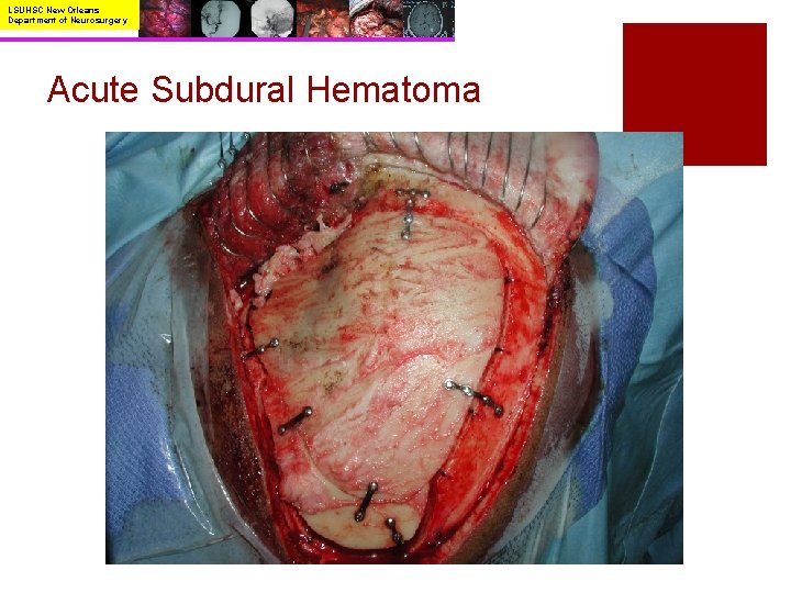 LSUHSC New Orleans Department of Neurosurgery Acute Subdural Hematoma 