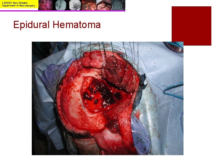 LSUHSC New Orleans Department of Neurosurgery Epidural Hematoma 