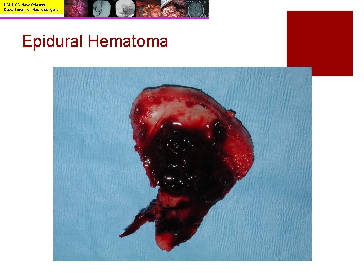 LSUHSC New Orleans Department of Neurosurgery Epidural Hematoma 