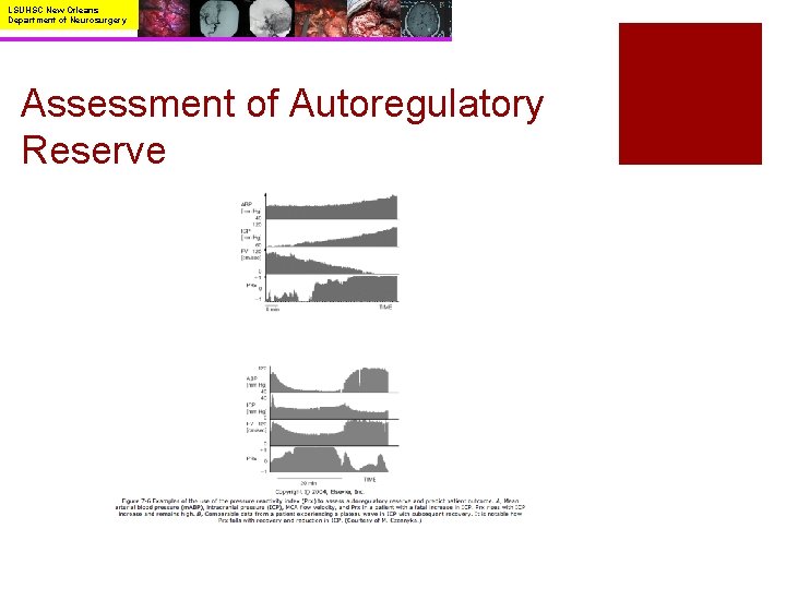 LSUHSC New Orleans Department of Neurosurgery Assessment of Autoregulatory Reserve 