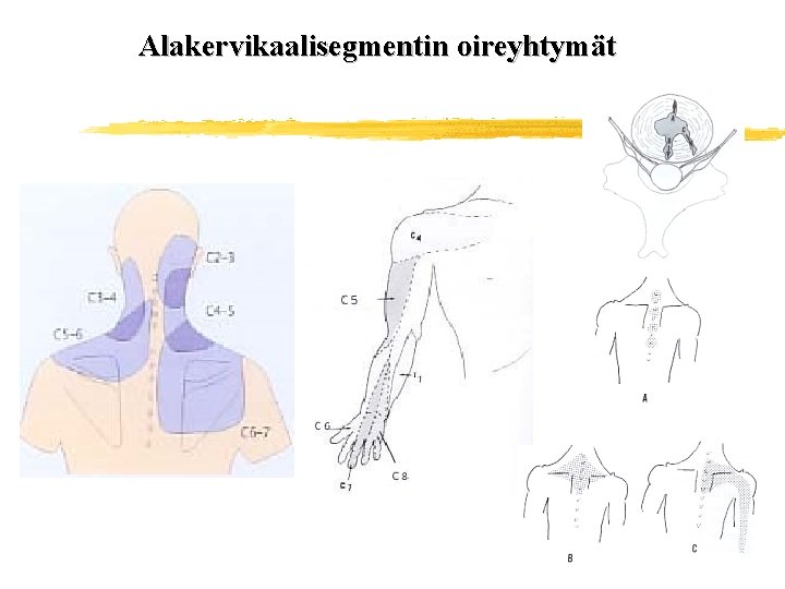 Alakervikaalisegmentin oireyhtymät 