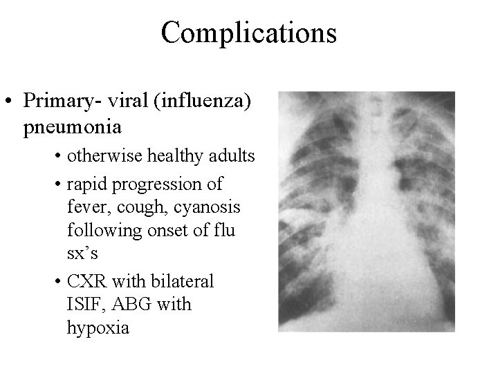 Complications • Primary- viral (influenza) pneumonia • otherwise healthy adults • rapid progression of Complications • Primary- viral (influenza) pneumonia • otherwise healthy adults • rapid progression of