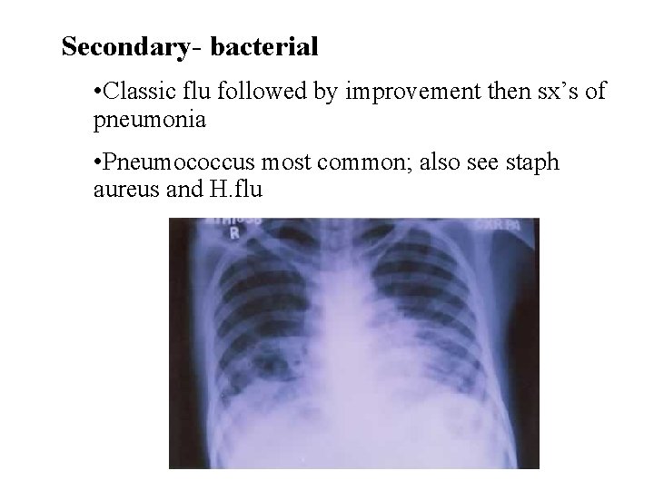 Secondary- bacterial • Classic flu followed by improvement then sx’s of pneumonia • Pneumococcus Secondary- bacterial • Classic flu followed by improvement then sx’s of pneumonia • Pneumococcus
