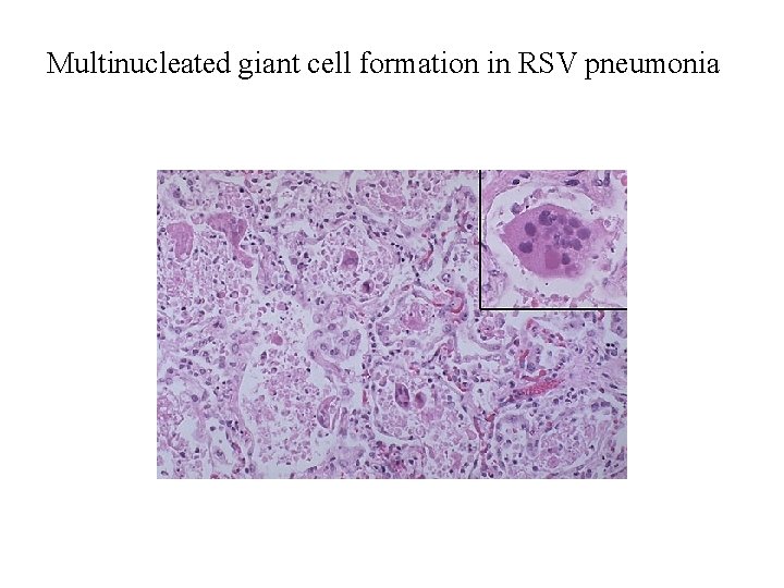 Multinucleated giant cell formation in RSV pneumonia Multinucleated giant cell formation in RSV pneumonia