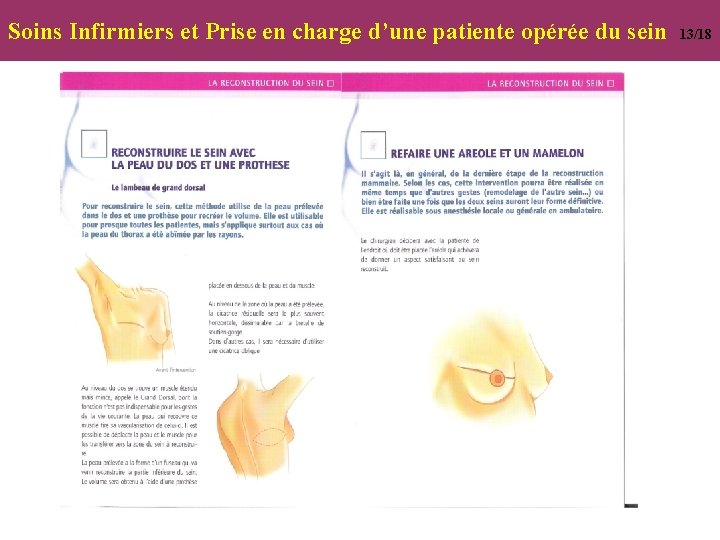 Soins Infirmiers et Prise en charge d’une patiente opérée du sein 13/18 