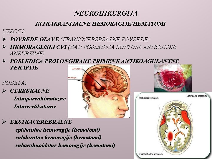 NEUROHIRURGIJA INTRAKRANIJALNE HEMORAGIJE/HEMATOMI UZROCI: Ø POVREDE GLAVE (KRANIOCEREBRALNE POVREDE) Ø HEMORAGIJSKI CVI (KAO POSLEDICA