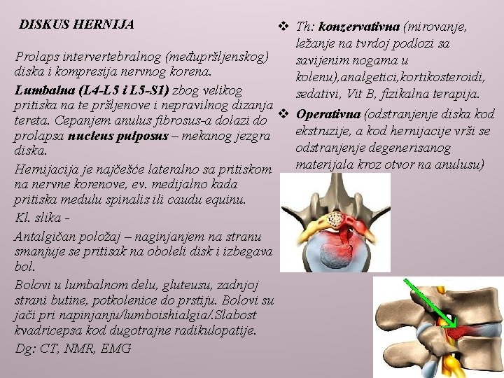 DISKUS HERNIJA v Th: konzervativna (mirovanje, ležanje na tvrdoj podlozi sa Prolaps intervertebralnog (međupršljenskog)