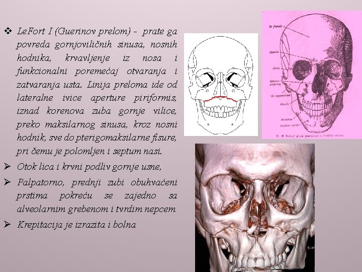 v Le. Fort I (Guerinov prelom) - prate ga povreda gornjoviličnih sinusa, nosnih hodnika,