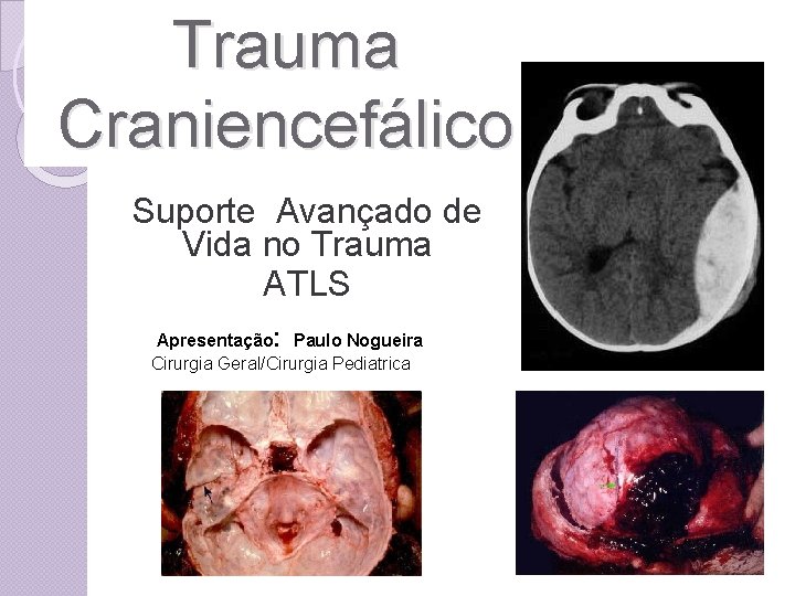 Trauma Craniencefálico Suporte Avançado de Vida no Trauma ATLS Apresentação: Paulo Nogueira Cirurgia Geral/Cirurgia