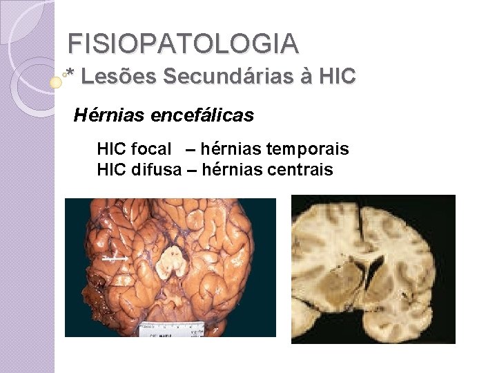 FISIOPATOLOGIA * Lesões Secundárias à HIC Hérnias encefálicas HIC focal – hérnias temporais HIC