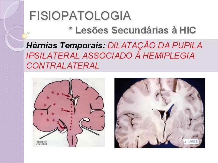 FISIOPATOLOGIA * Lesões Secundárias à HIC Hérnias Temporais: DILATAÇÃO DA PUPILA IPSILATERAL ASSOCIADO À