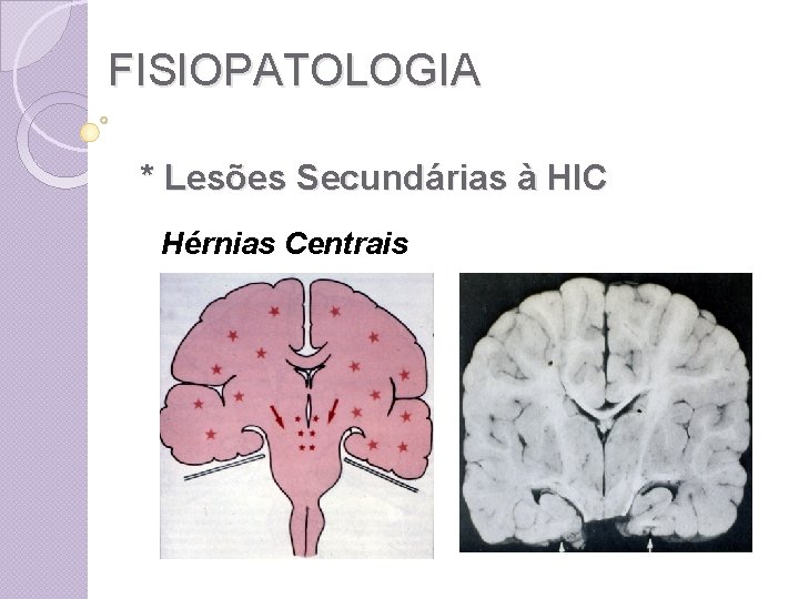 FISIOPATOLOGIA * Lesões Secundárias à HIC Hérnias Centrais 