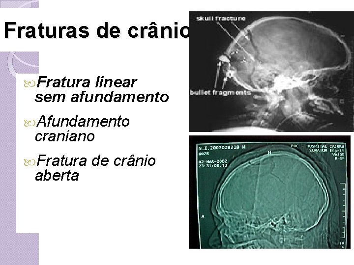 Fraturas de crânio Fratura linear sem afundamento Afundamento craniano Fratura aberta de crânio 