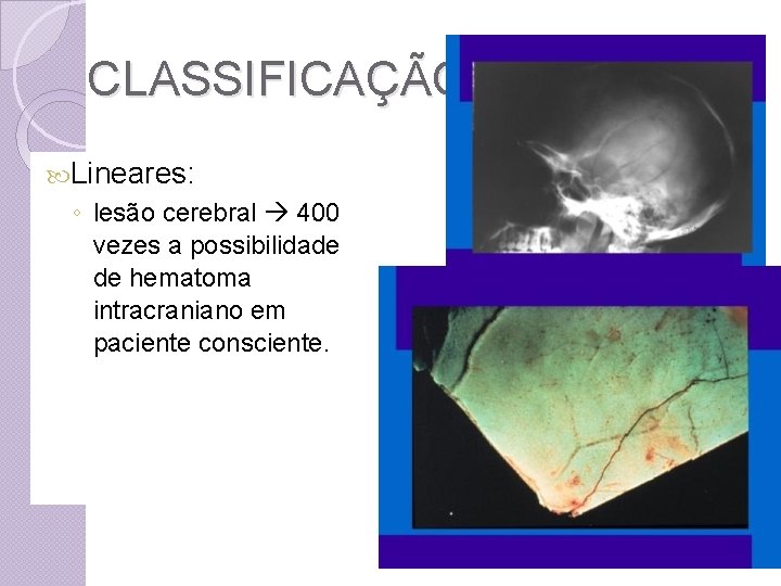 CLASSIFICAÇÃO Lineares: ◦ lesão cerebral 400 vezes a possibilidade de hematoma intracraniano em paciente