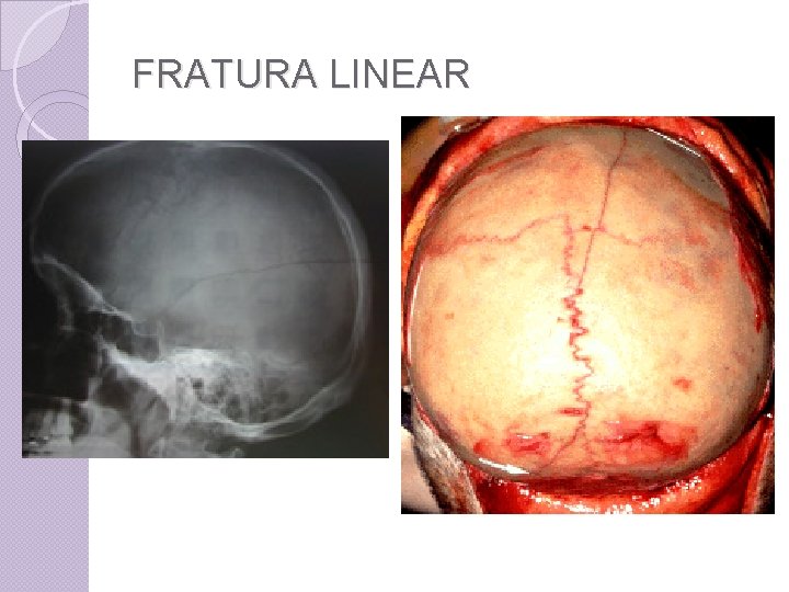 FRATURA LINEAR 