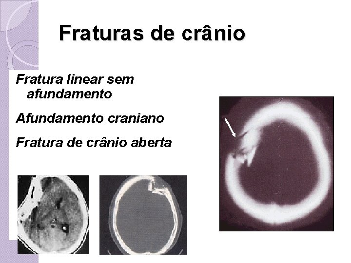 Fraturas de crânio Fratura linear sem afundamento Afundamento craniano Fratura de crânio aberta 