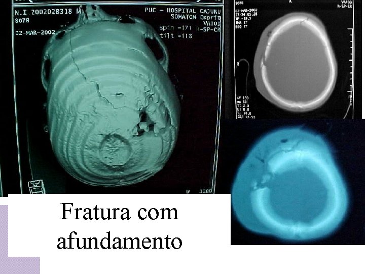 Fratura com afundamento 