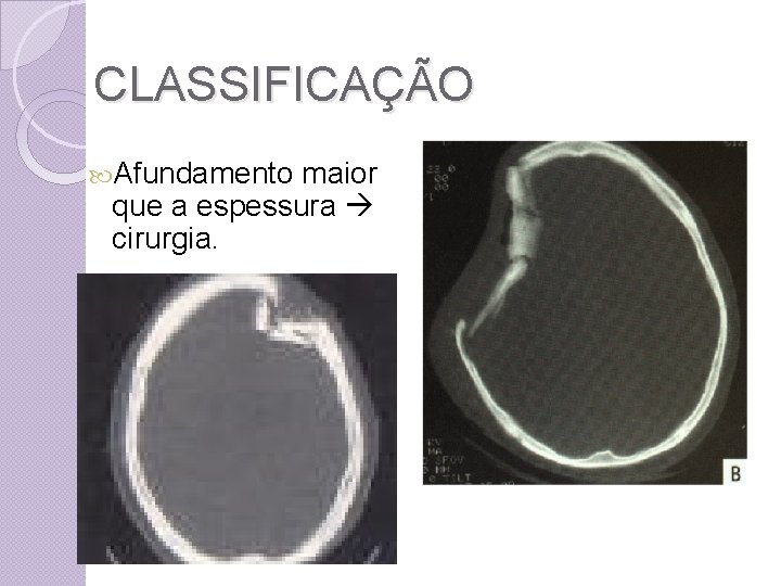 CLASSIFICAÇÃO Afundamento maior que a espessura cirurgia. 