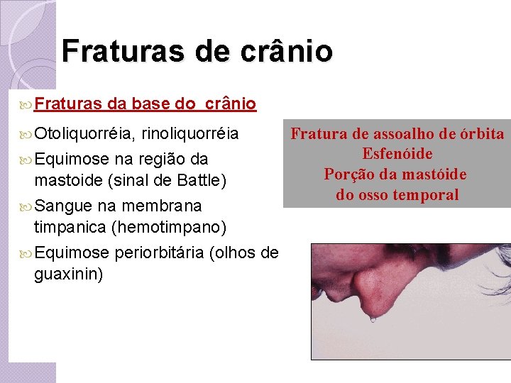 Fraturas de crânio Fraturas da base do crânio Otoliquorréia, rinoliquorréia Equimose na região da