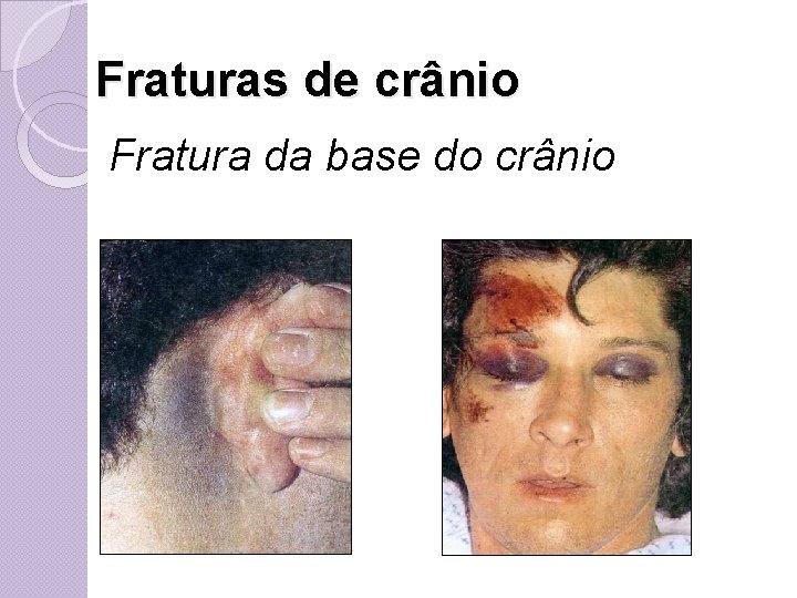 Fraturas de crânio Fratura da base do crânio 
