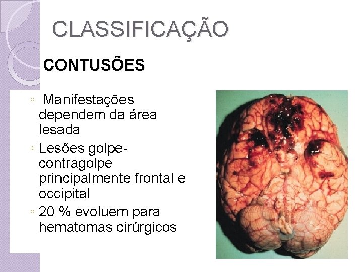 CLASSIFICAÇÃO CONTUSÕES ◦ Manifestações dependem da área lesada ◦ Lesões golpecontragolpe principalmente frontal e