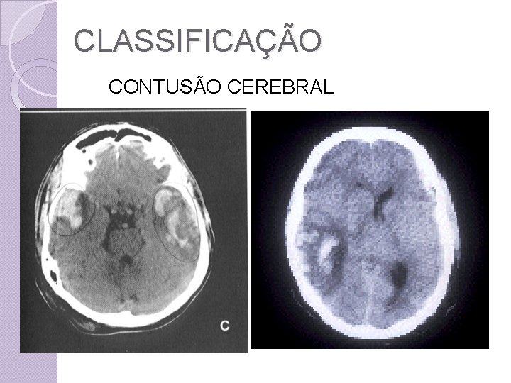 CLASSIFICAÇÃO CONTUSÃO CEREBRAL 