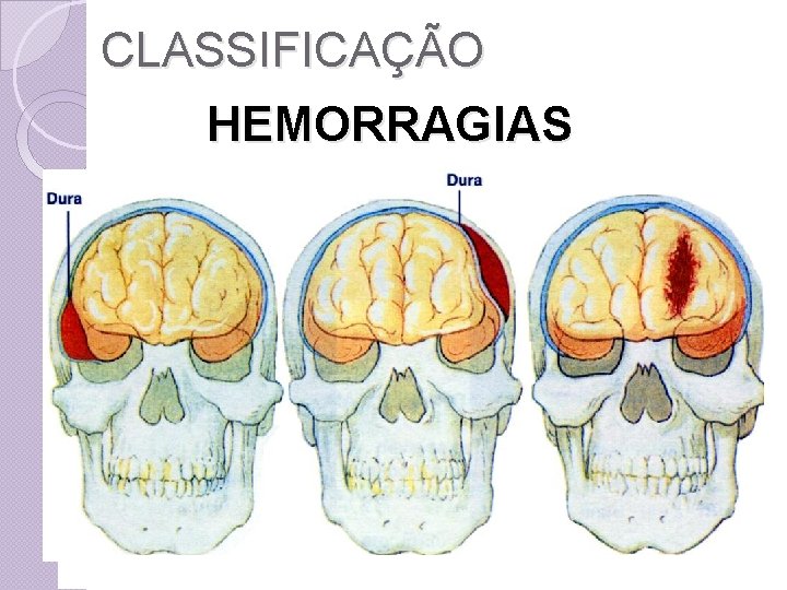 CLASSIFICAÇÃO HEMORRAGIAS Hematomas: Subdural Epidural Intracerebral 