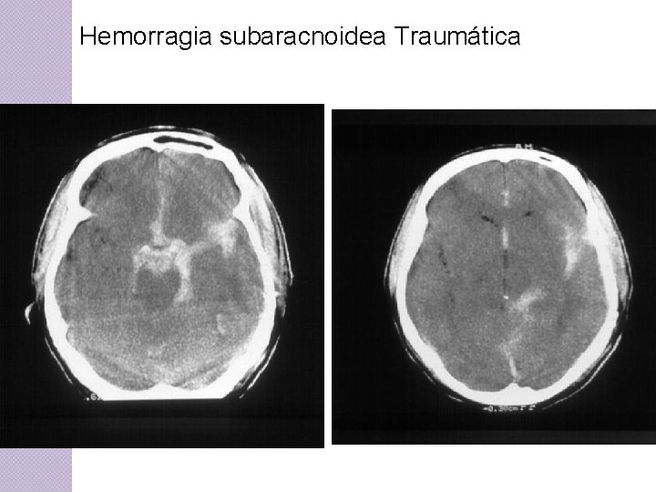 Hemorragia subaracnoidea Traumática 