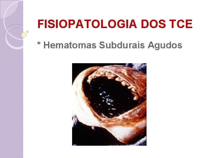 FISIOPATOLOGIA DOS TCE * Hematomas Subdurais Agudos 