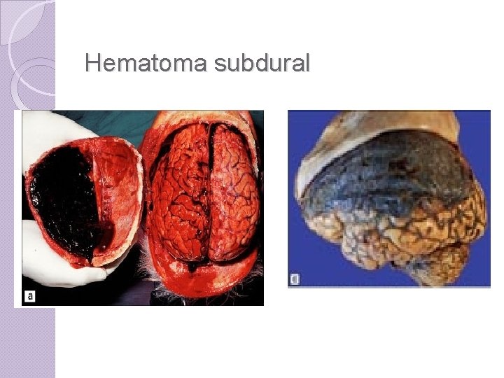Hematoma subdural 