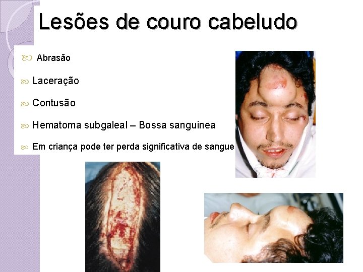 Lesões de couro cabeludo Abrasão Laceração Contusão Hematoma subgaleal – Bossa sanguinea Em criança