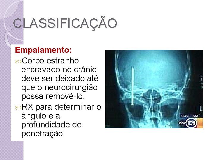 CLASSIFICAÇÃO Empalamento: Corpo estranho encravado no crânio deve ser deixado até que o neurocirurgião