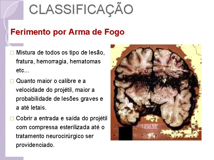 CLASSIFICAÇÃO Ferimento por Arma de Fogo � Mistura de todos os tipo de lesão,