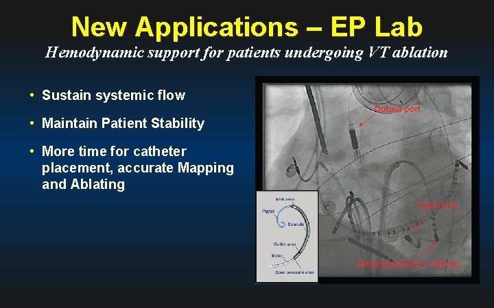 New Applications – EP Lab Hemodynamic support for patients undergoing VT ablation • Sustain