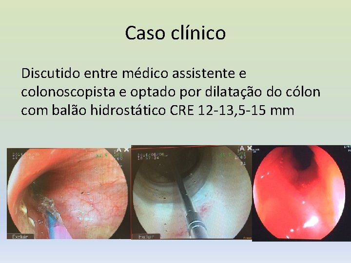 Caso clínico Discutido entre médico assistente e colonoscopista e optado por dilatação do cólon