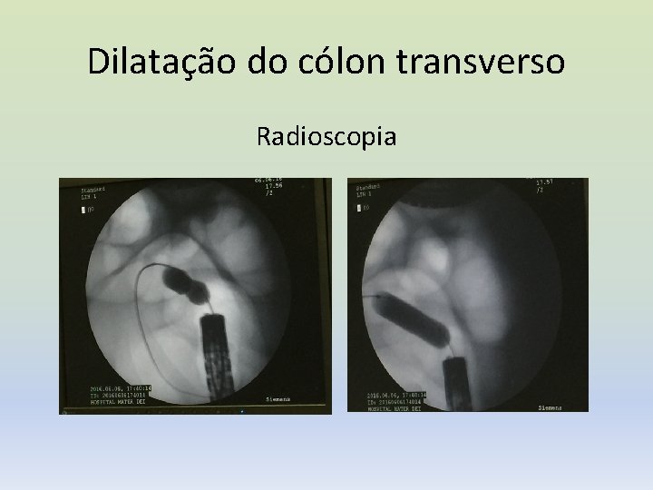 Dilatação do cólon transverso Radioscopia 