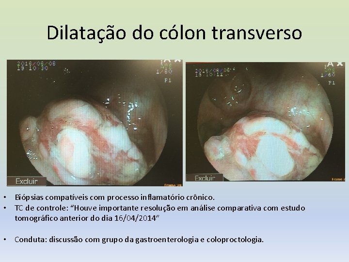 Dilatação do cólon transverso • Biópsias compatíveis com processo inflamatório crônico. • TC de