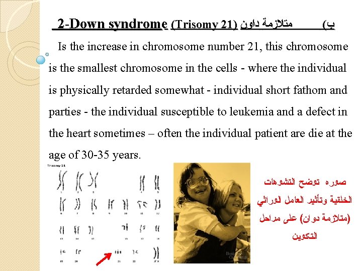 2 -Down syndrome (Trisomy 21) ﻣﺘﻼﺯﻣﺔ ﺩﺍﻭﻥ ( ﺏ Is the increase in chromosome