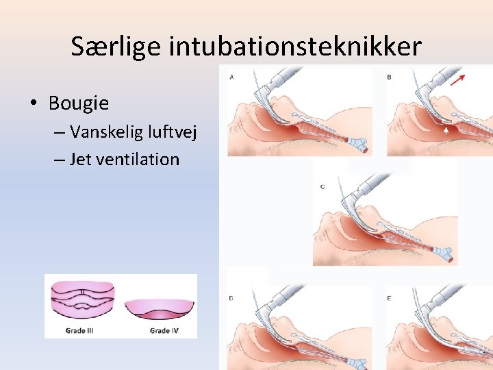 Særlige intubationsteknikker • Bougie – Vanskelig luftvej – Jet ventilation 